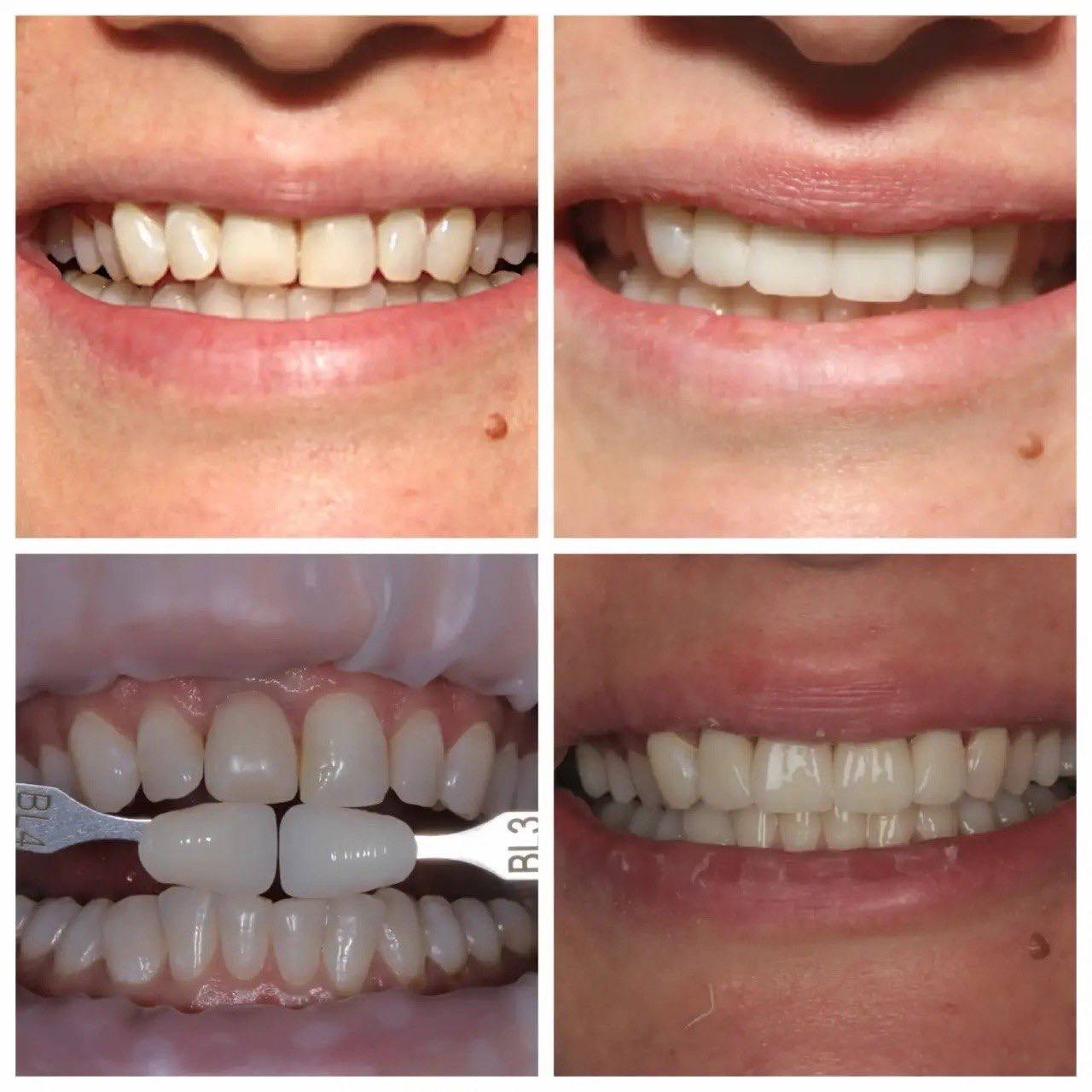 Результат лечения в стоматологии Smile Kit