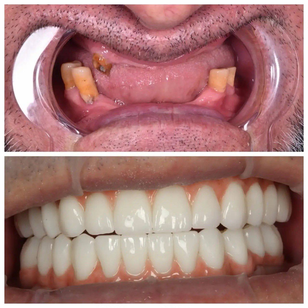 Результат лечения в стоматологии Smile Kit