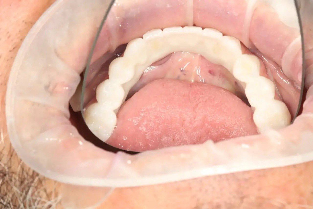 Результат лечения в стоматологии Smile Kit