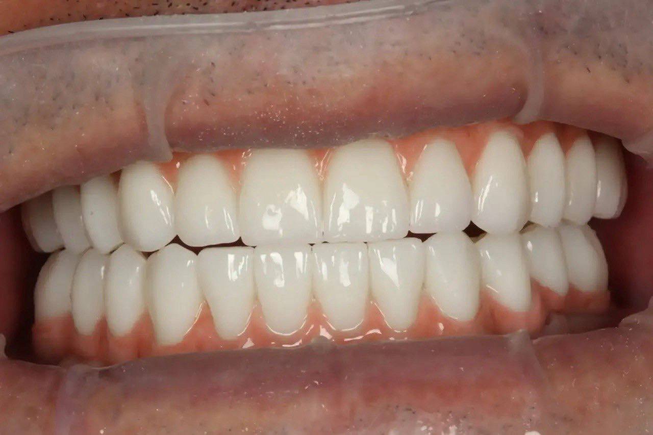 Результат лечения в стоматологии Smile Kit