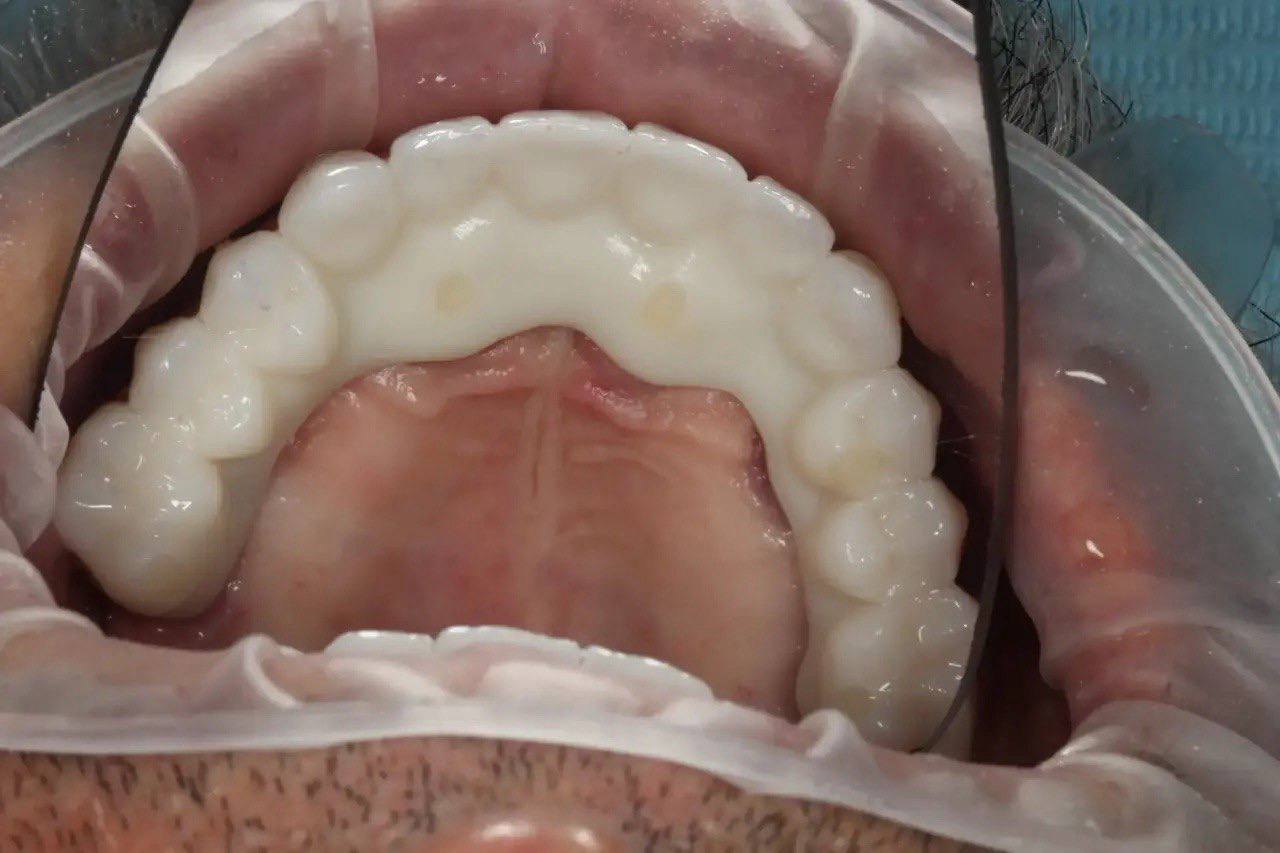 Результат лечения в стоматологии Smile Kit