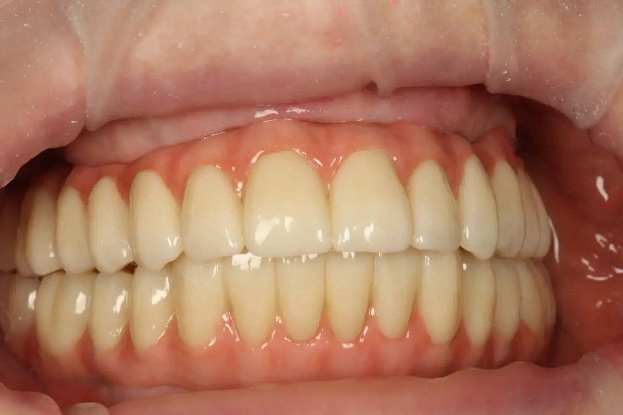 Результат лечения в стоматологии Smile Kit