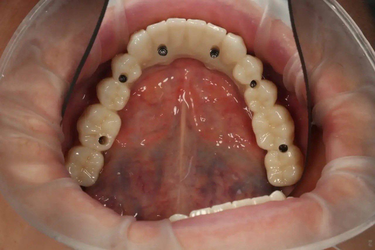 Результат лечения в стоматологии Smile Kit
