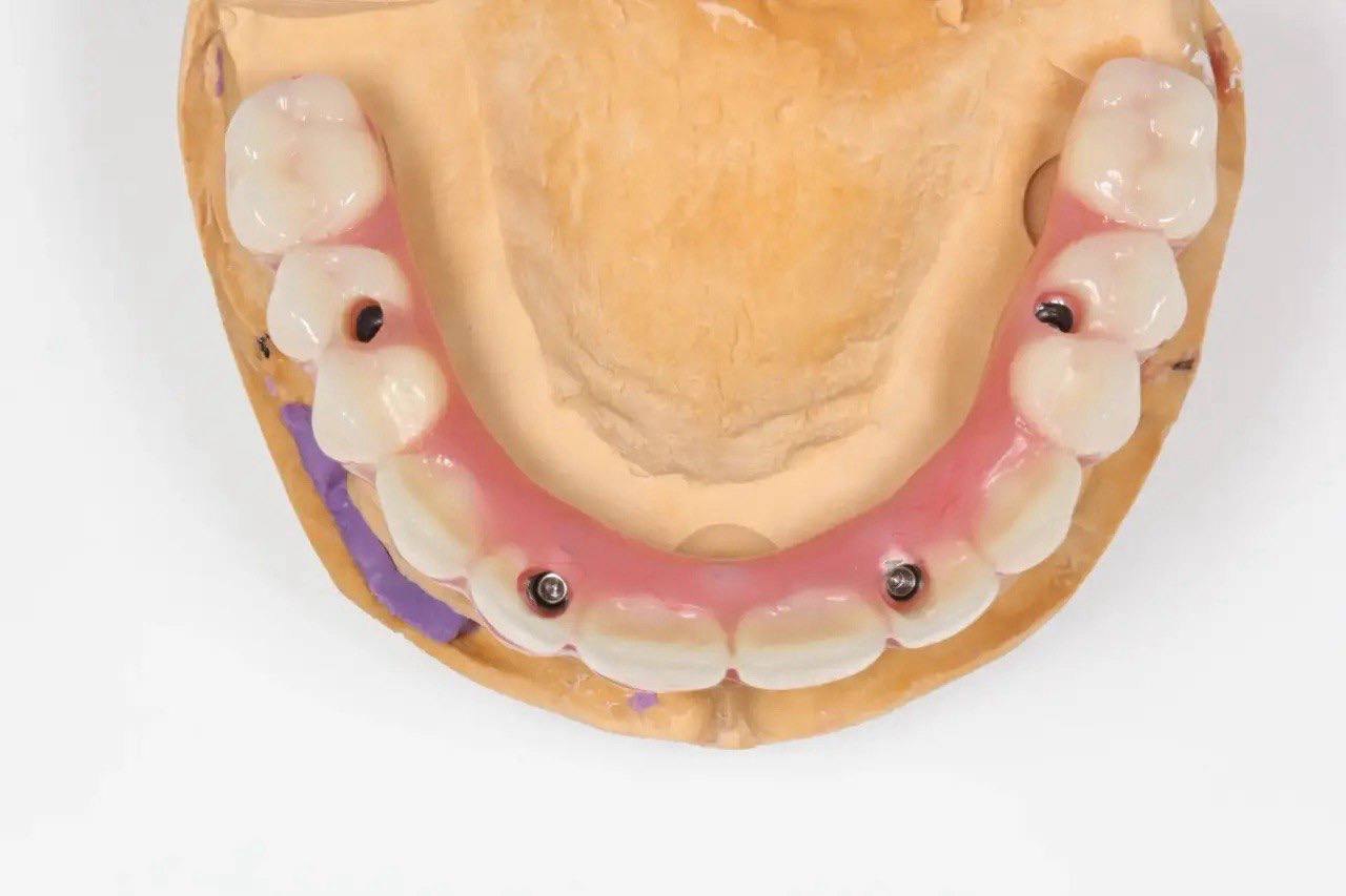 Результат лечения в стоматологии Smile Kit