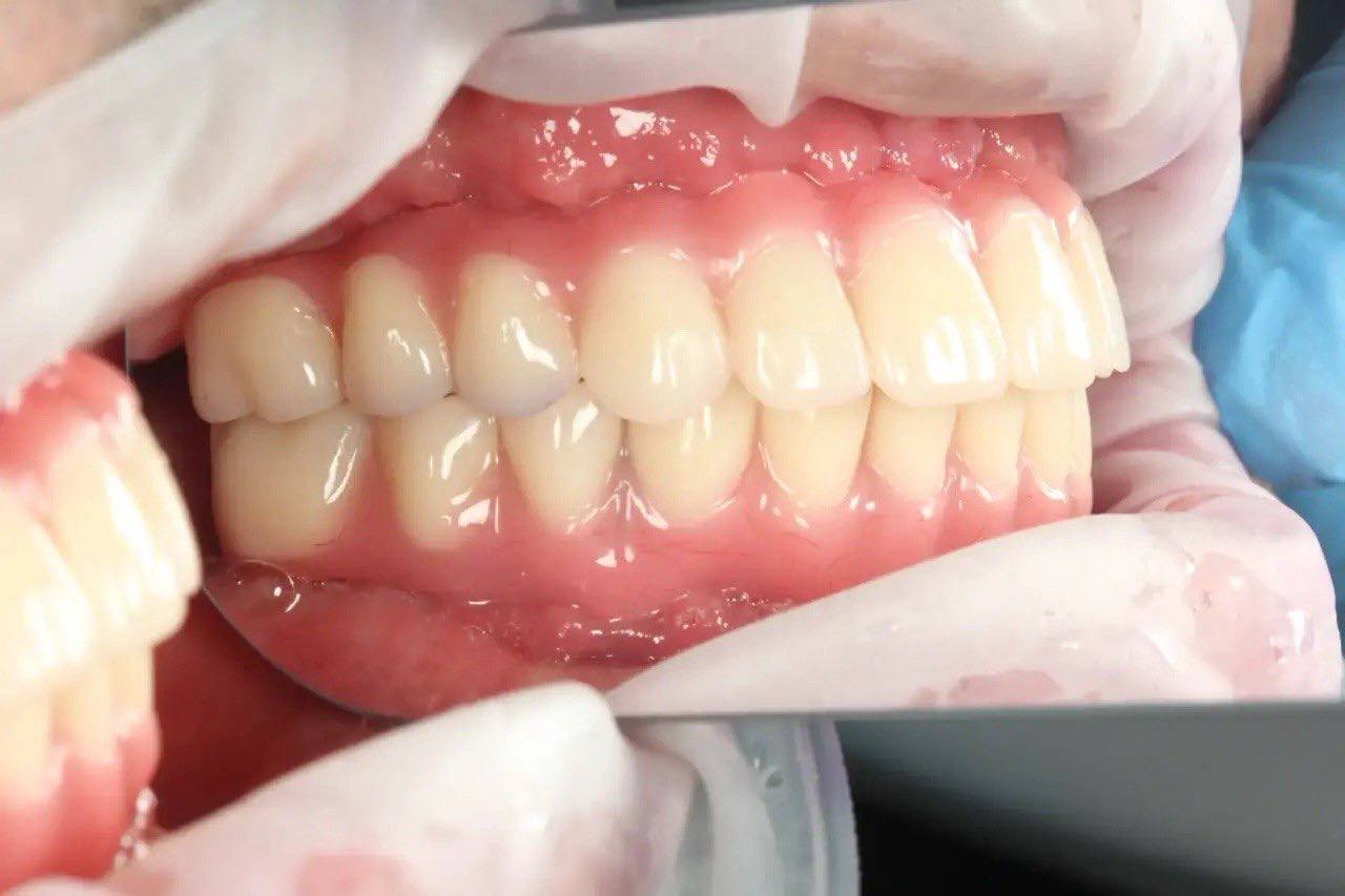 Результат лечения в стоматологии Smile Kit