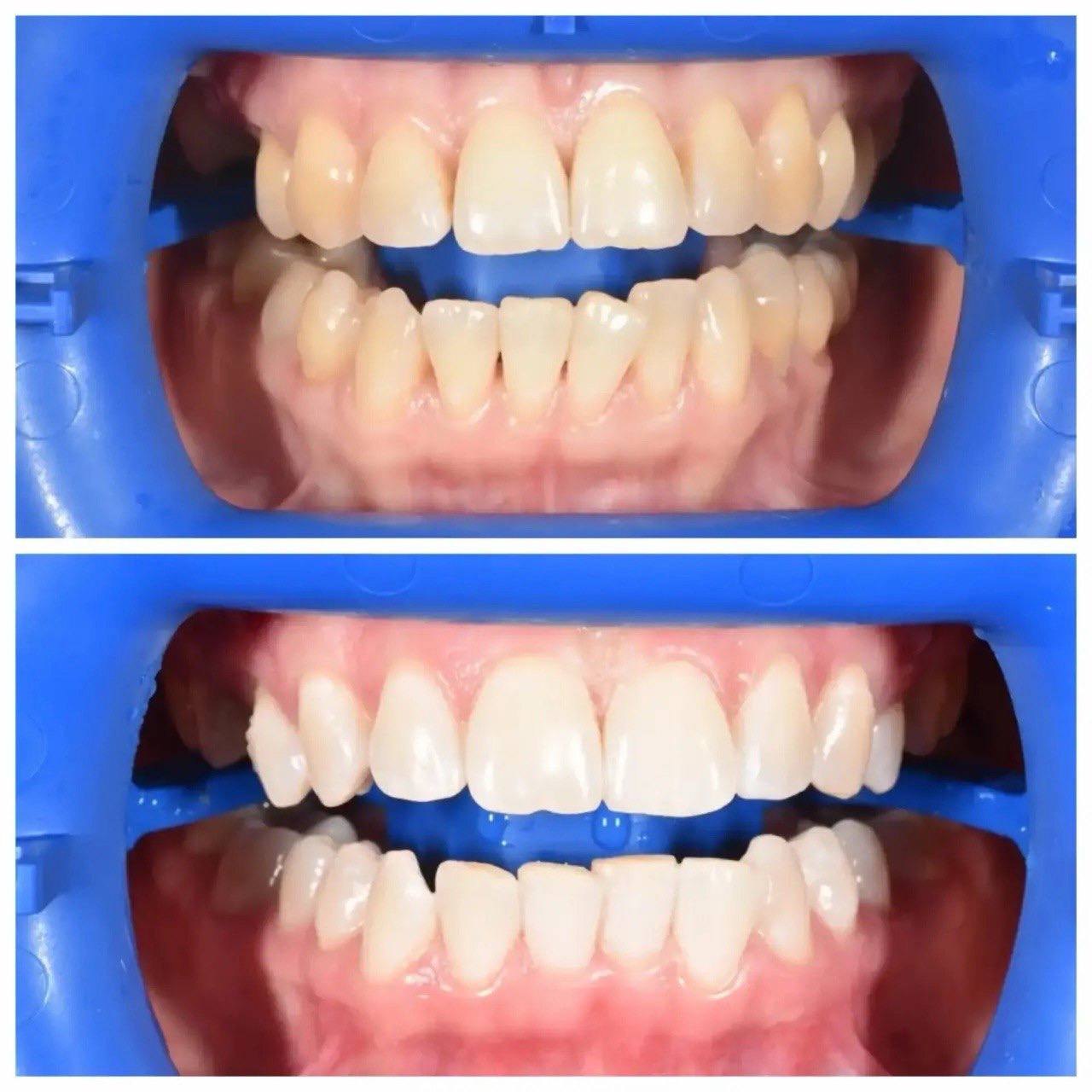 Результат лечения в стоматологии Smile Kit