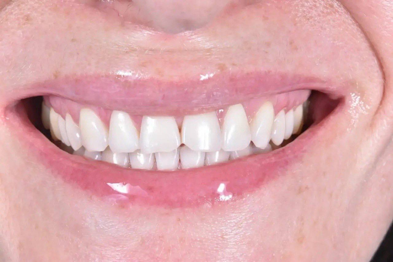 Результат лечения в стоматологии Smile Kit