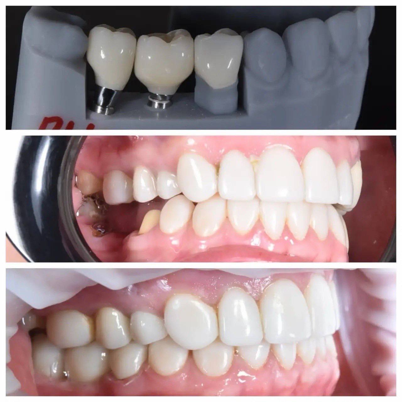Результат лечения в стоматологии Smile Kit