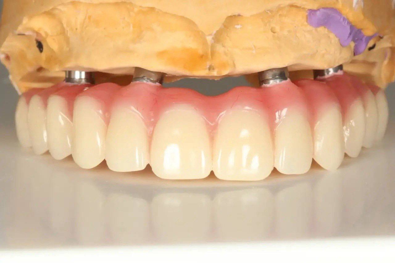 Результат лечения в стоматологии Smile Kit