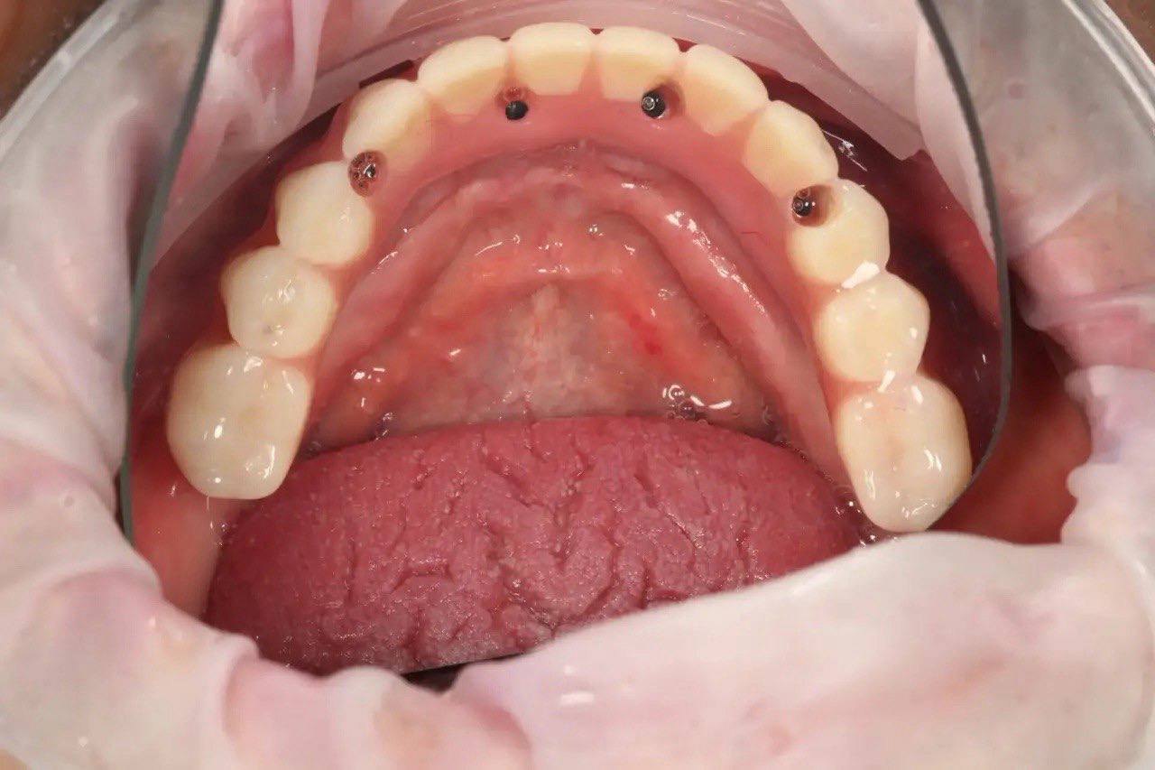 Результат лечения в стоматологии Smile Kit
