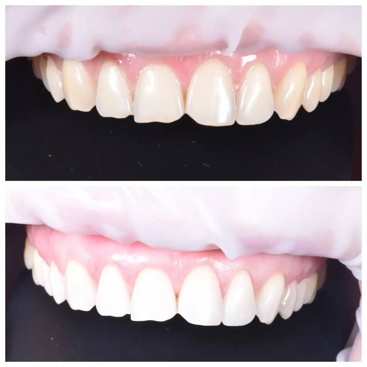 Результат лечения в стоматологии Smile Kit