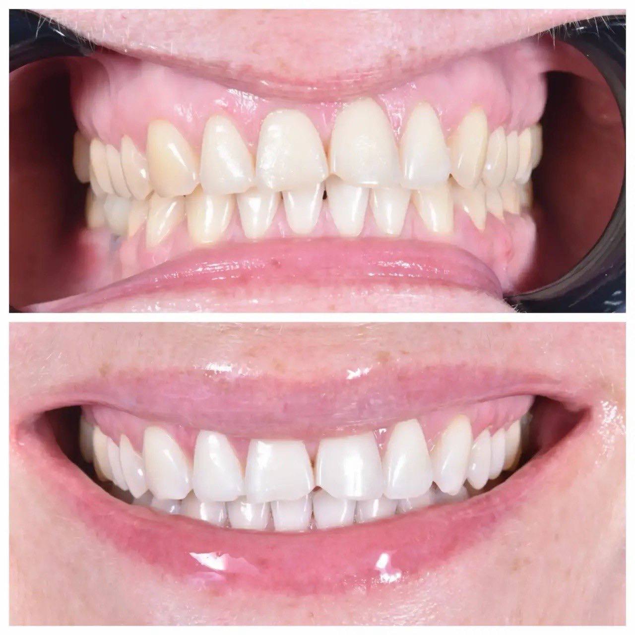 Результат лечения в стоматологии Smile Kit