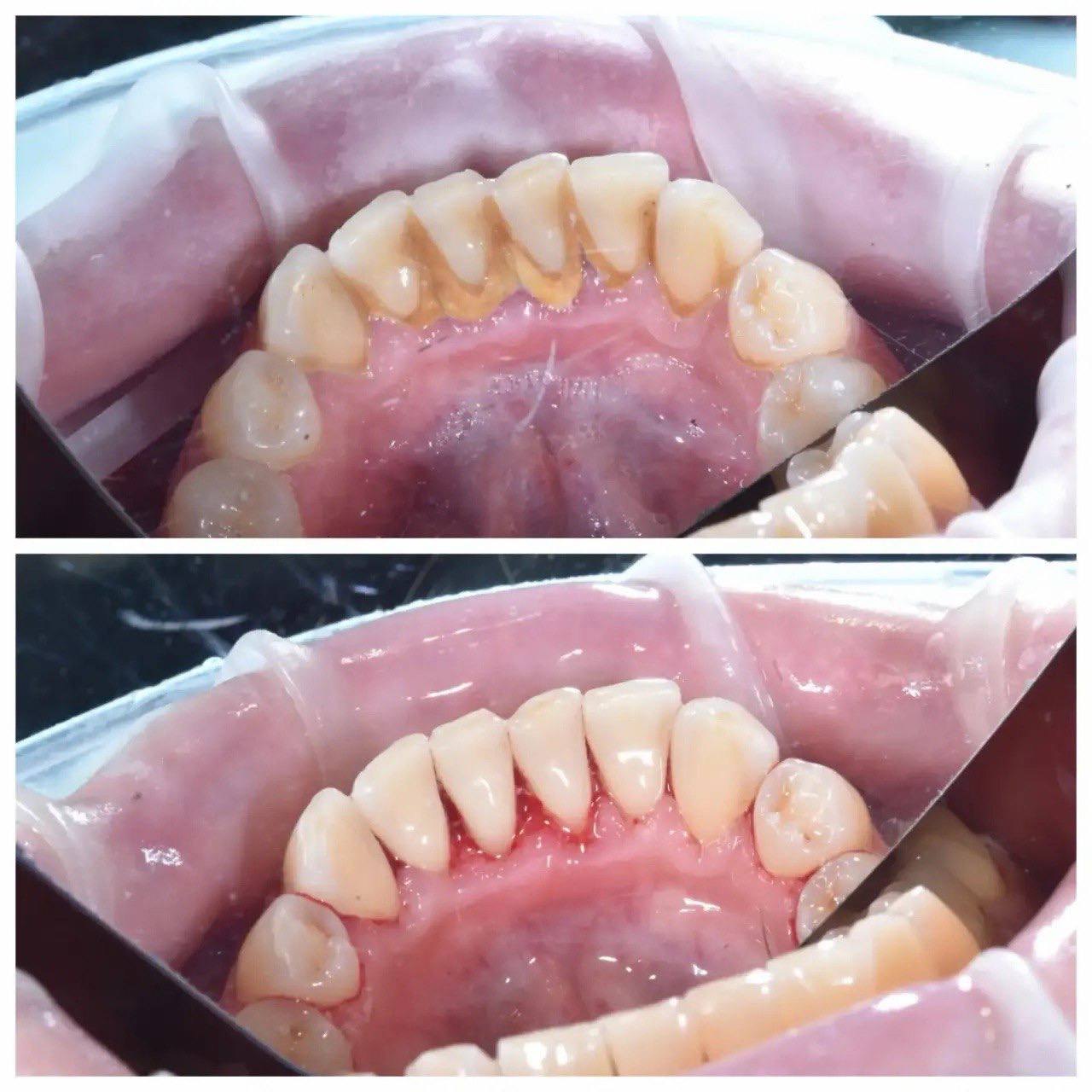 Результат лечения в стоматологии Smile Kit
