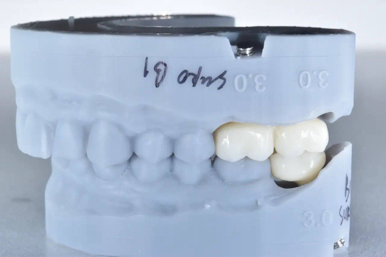 Результат лечения в стоматологии Smile Kit