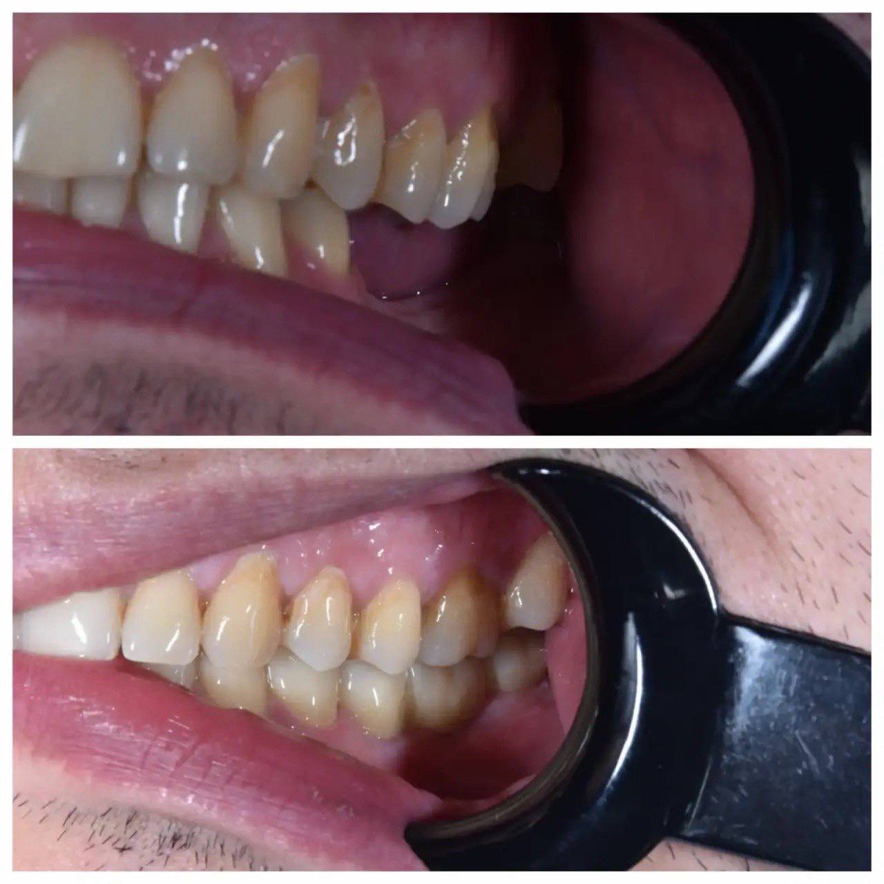 Результат лечения в стоматологии Smile Kit