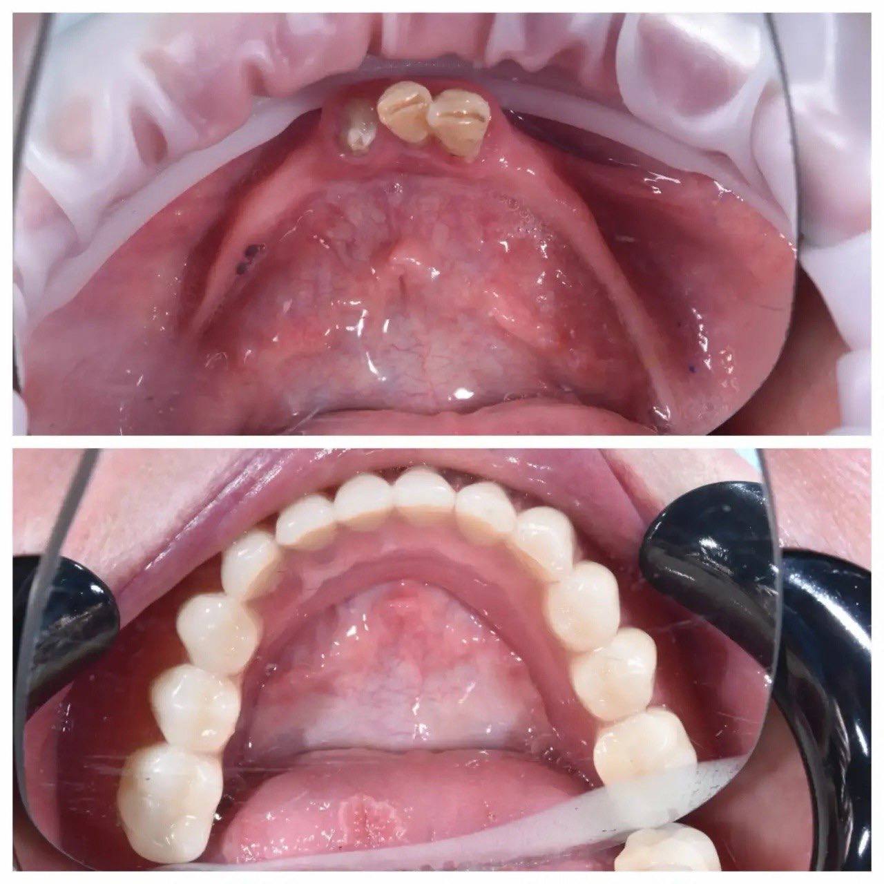 Результат лечения в стоматологии Smile Kit