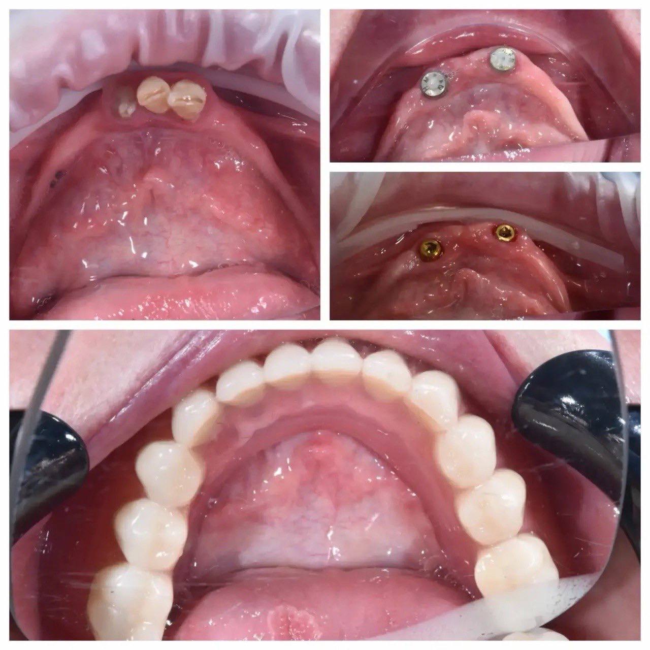 Результат лечения в стоматологии Smile Kit