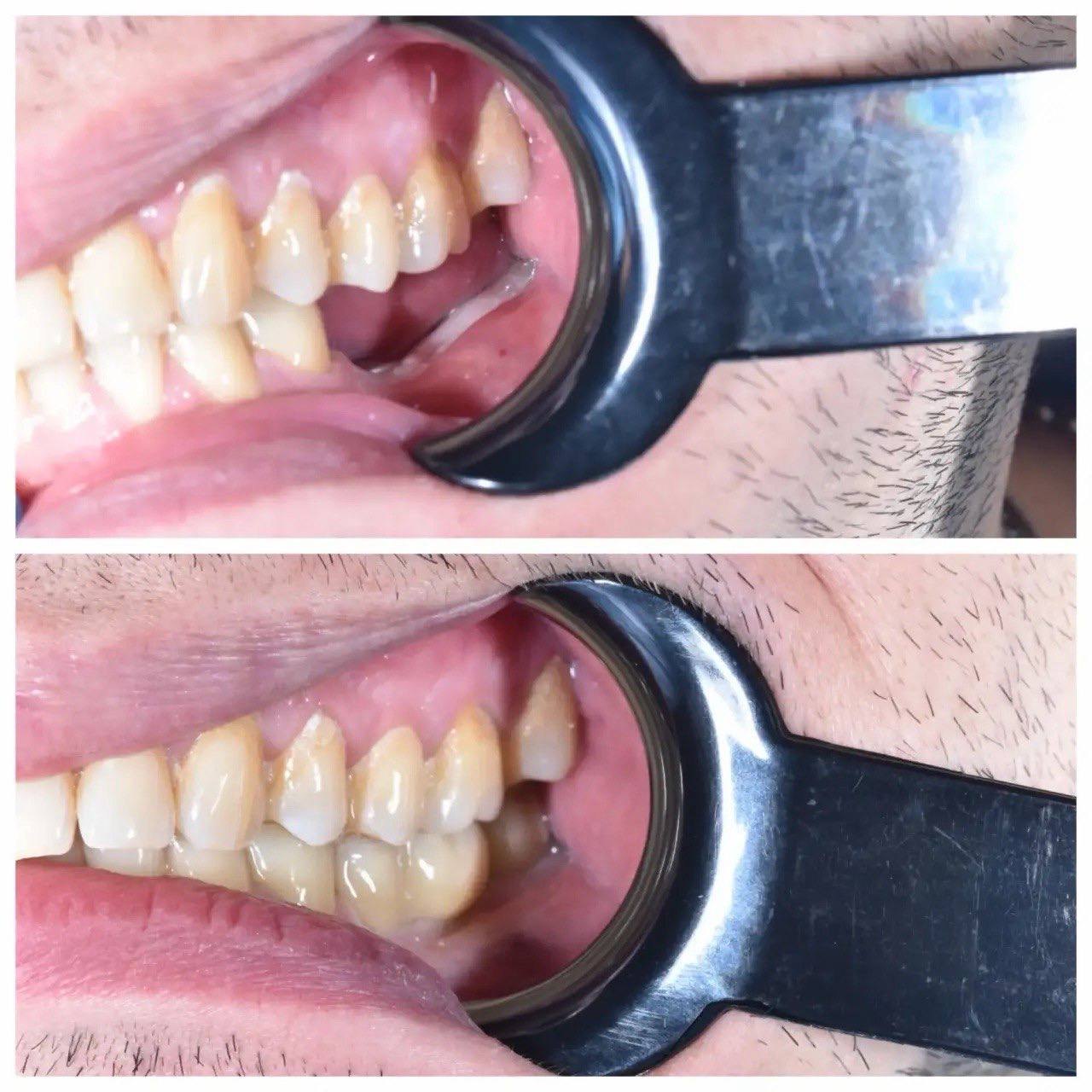 Результат лечения в стоматологии Smile Kit