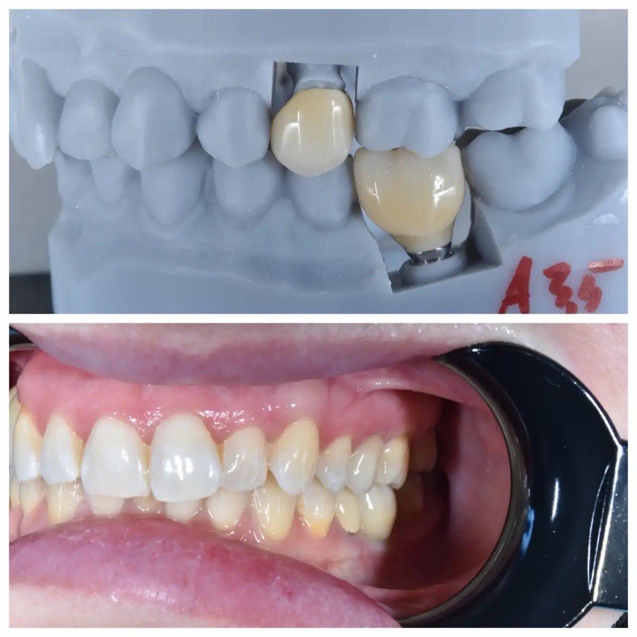 Результат лечения в стоматологии Smile Kit