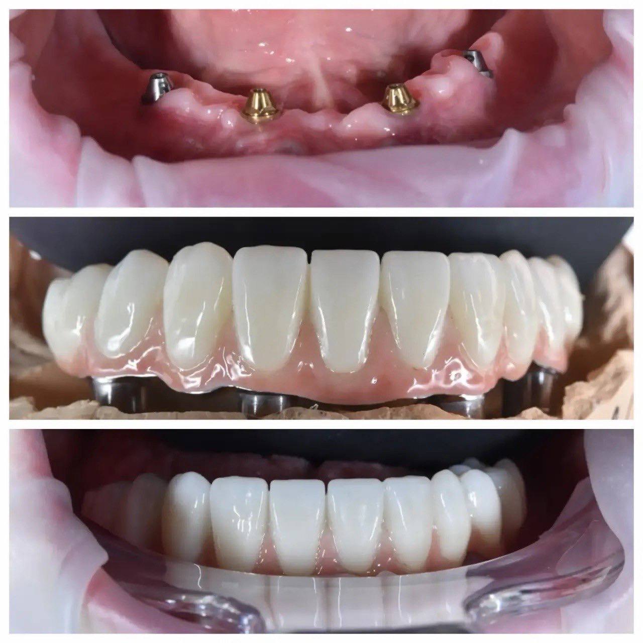 Результат лечения в стоматологии Smile Kit