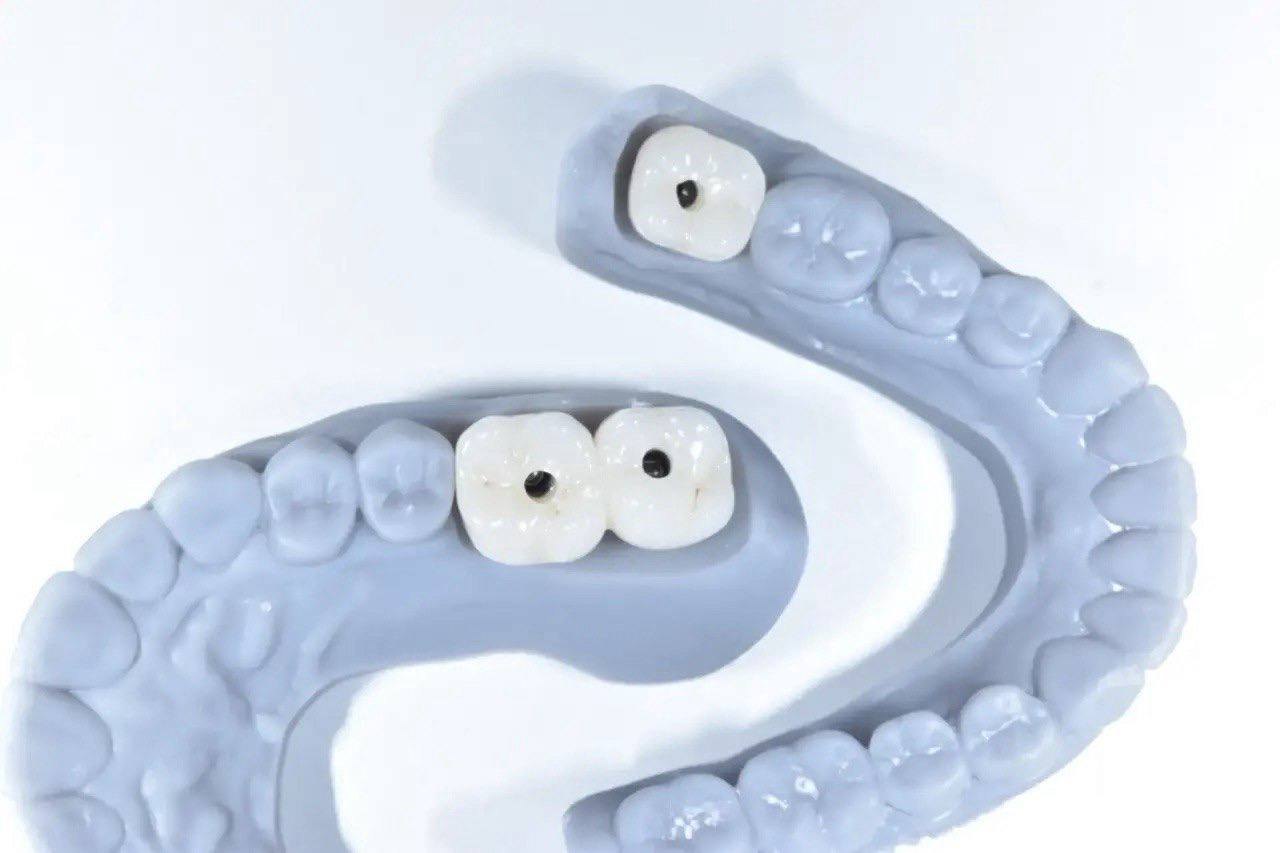 Результат лечения в стоматологии Smile Kit