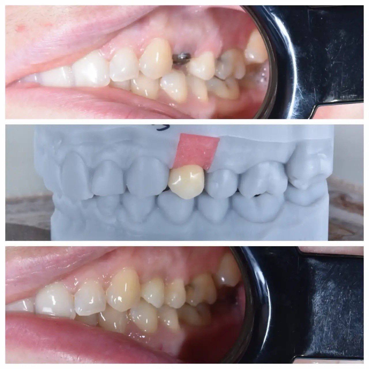 Результат лечения в стоматологии Smile Kit