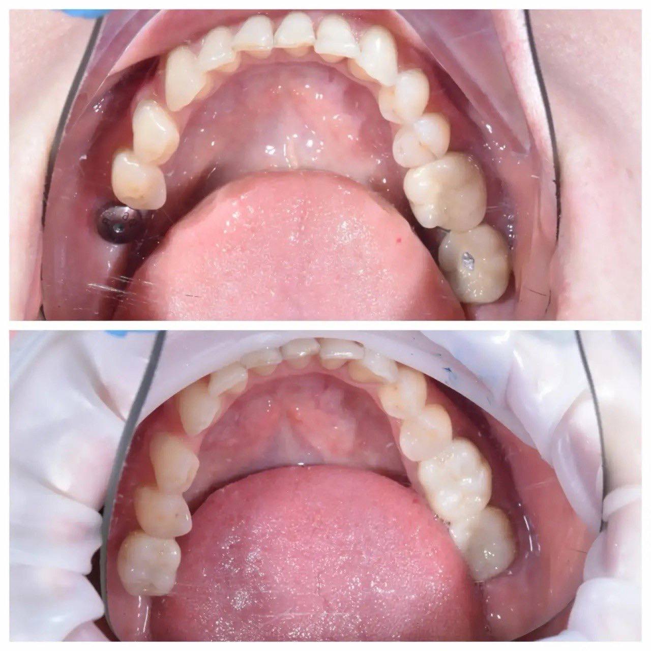 Результат лечения в стоматологии Smile Kit