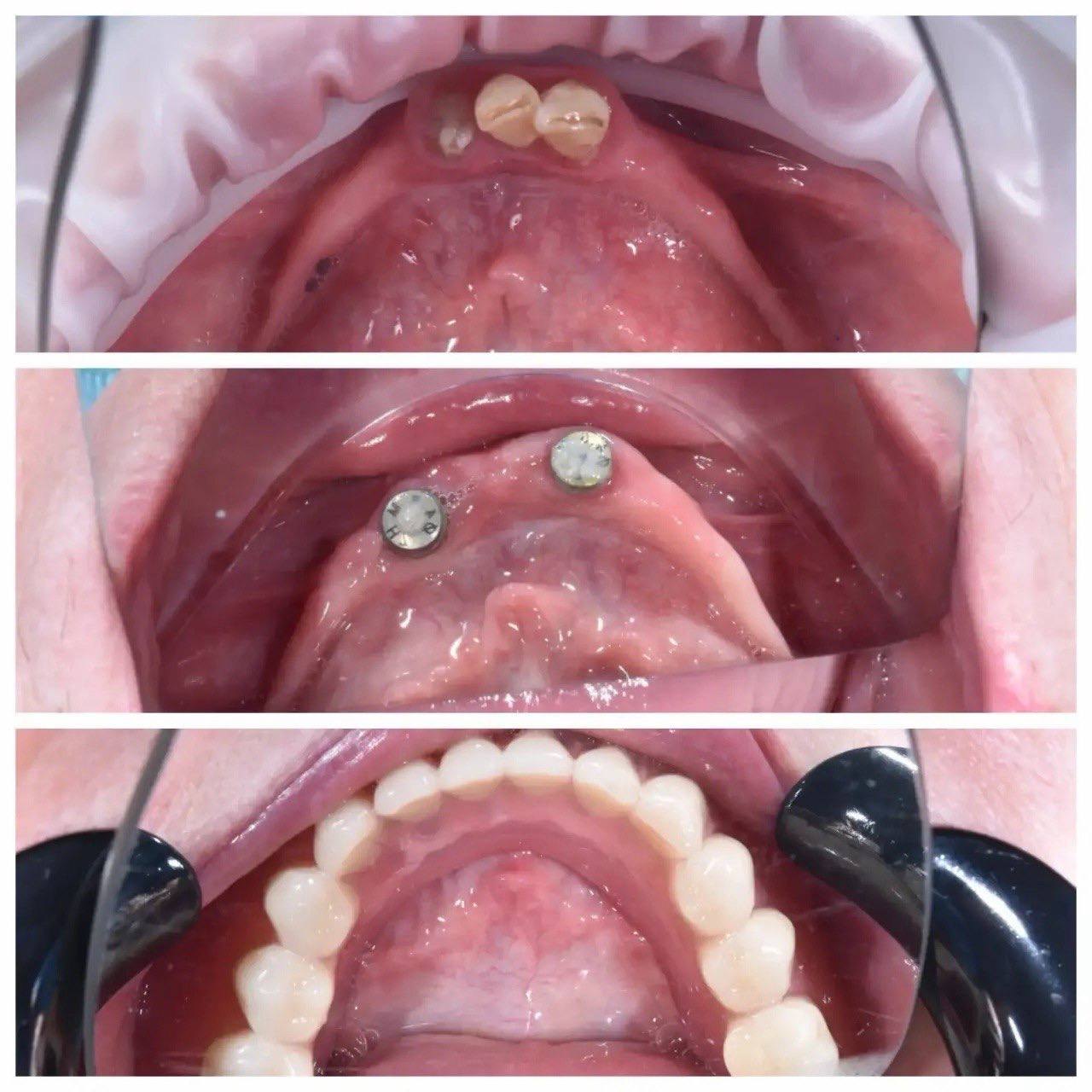 Результат лечения в стоматологии Smile Kit