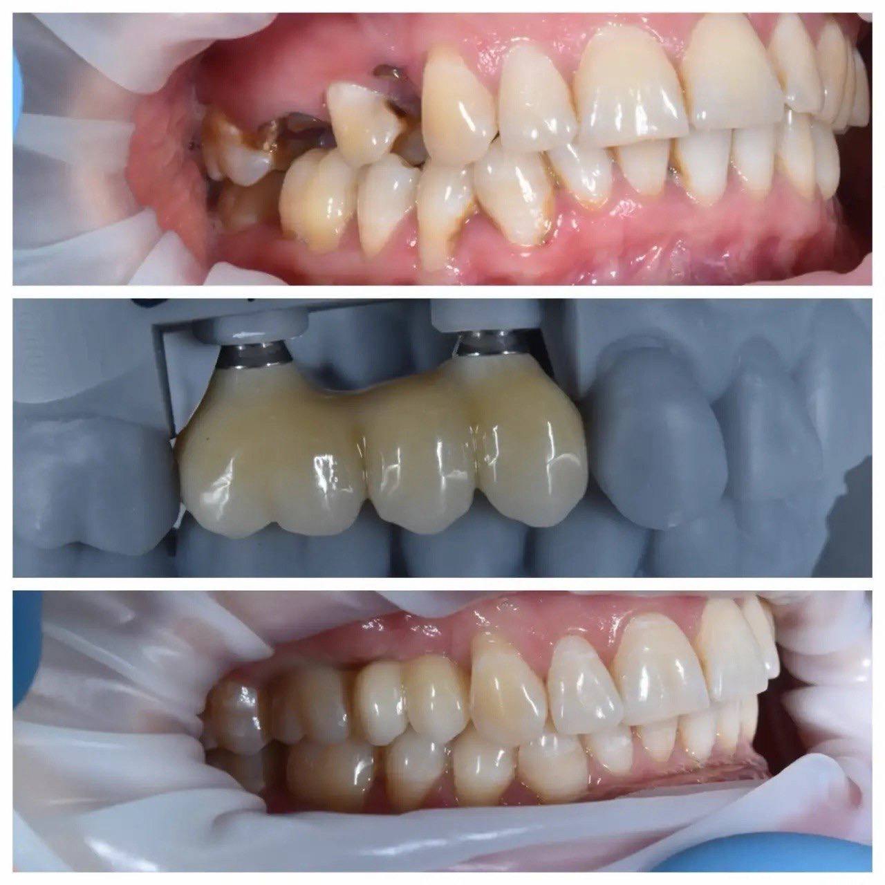 Результат лечения в стоматологии Smile Kit