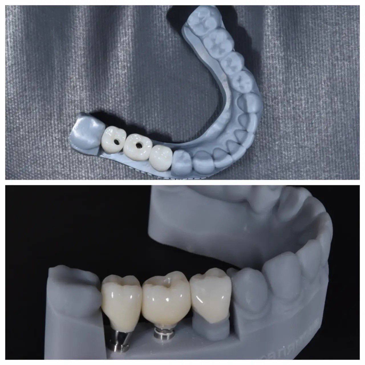Результат лечения в стоматологии Smile Kit