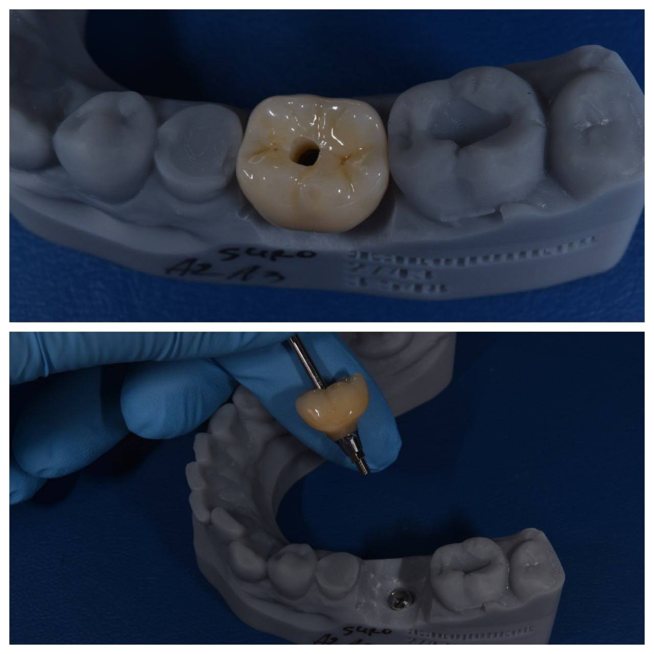 Результат лечения в стоматологии Smile Kit