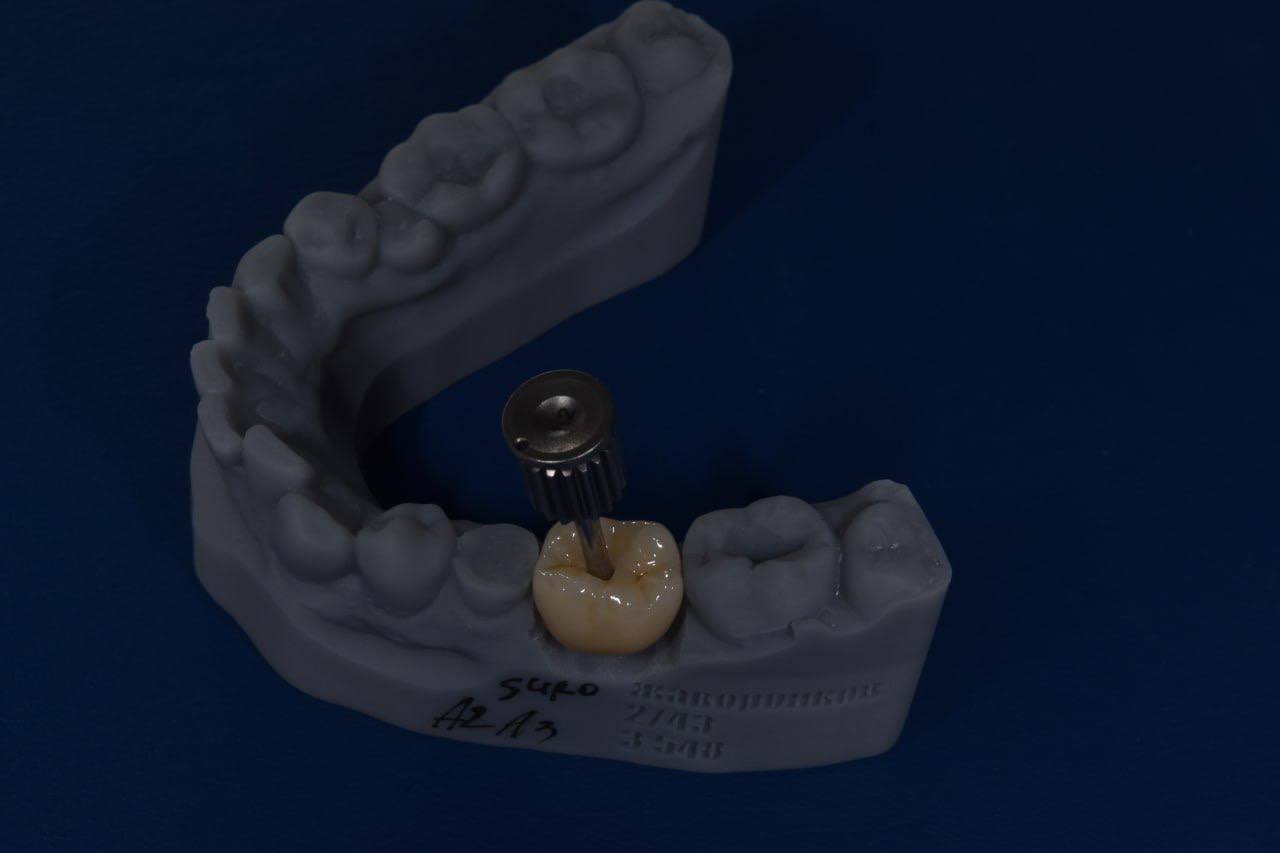 Результат лечения в стоматологии Smile Kit