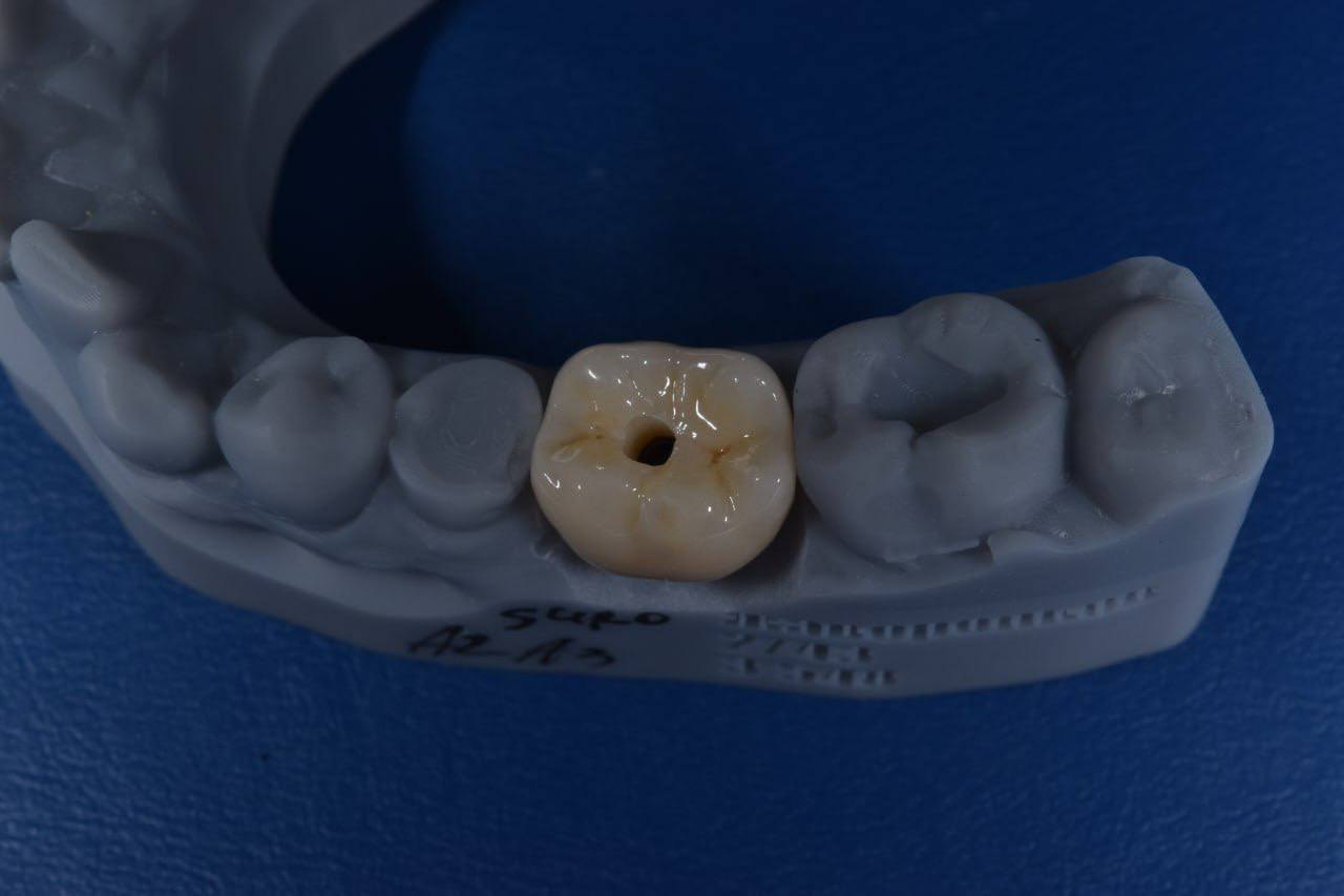 Результат лечения в стоматологии Smile Kit